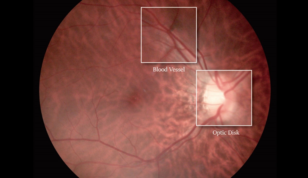 Mydriatic or Non Mydriatic Fundus Camera, Which Is Better?